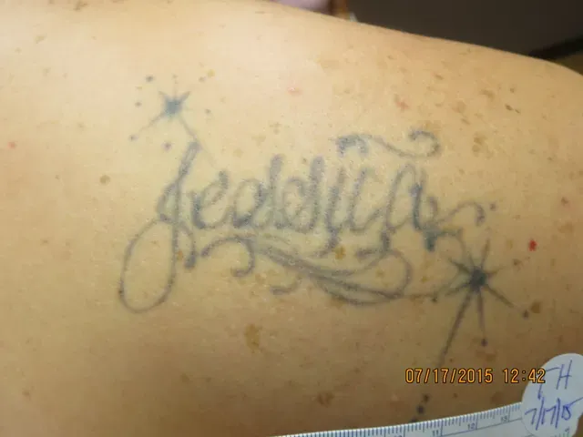 Tattoo before treatment example 1