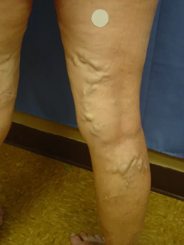 Before spider vein treatment